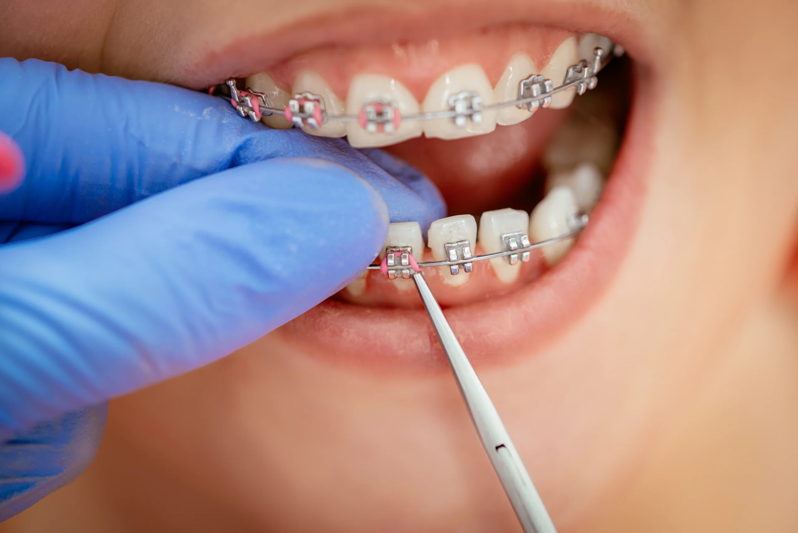 Dental Braces & Aligners