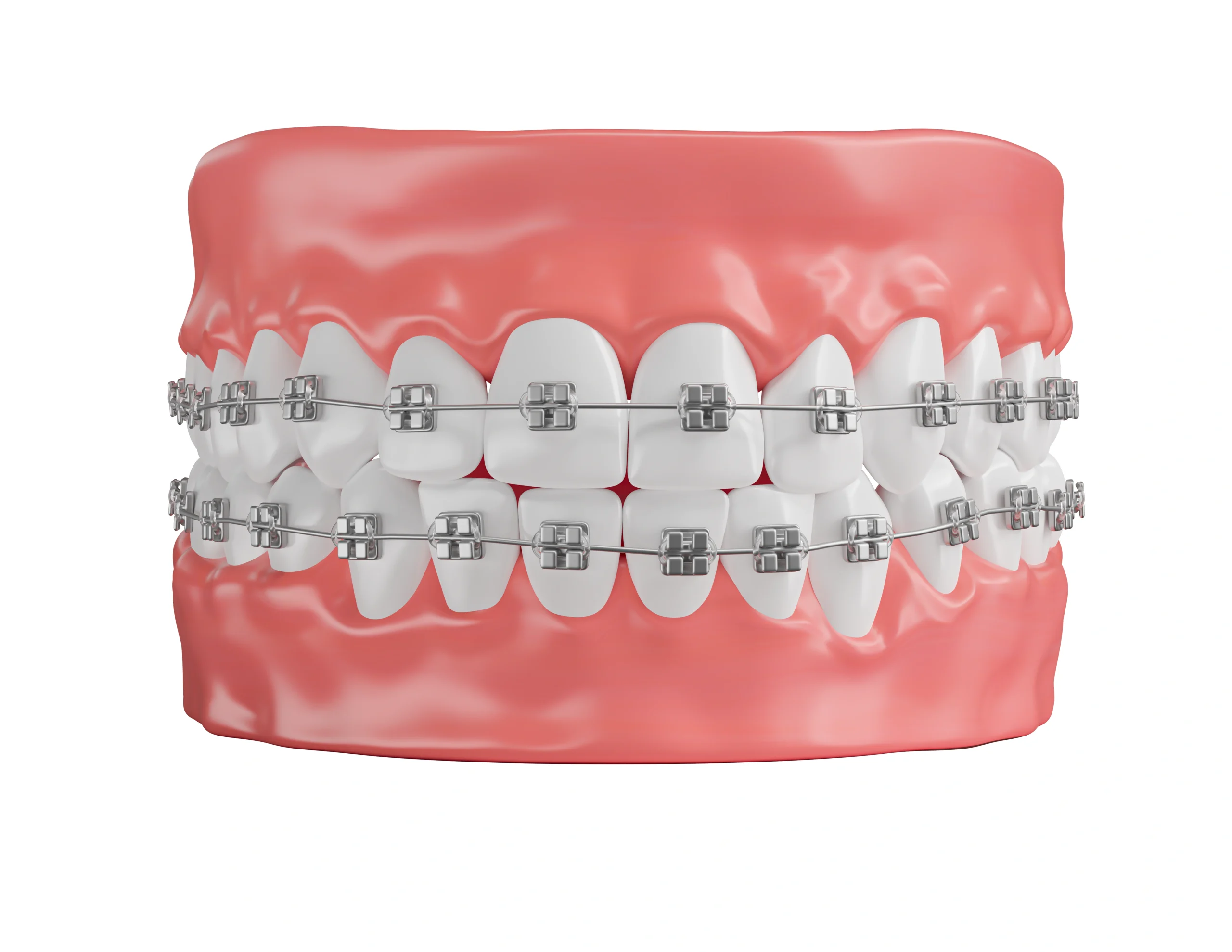 Clear Aligners