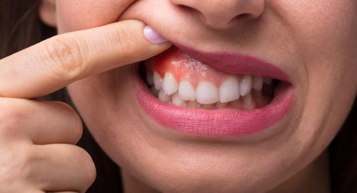 Gum Treatment