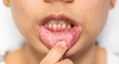Mouth Ulcer