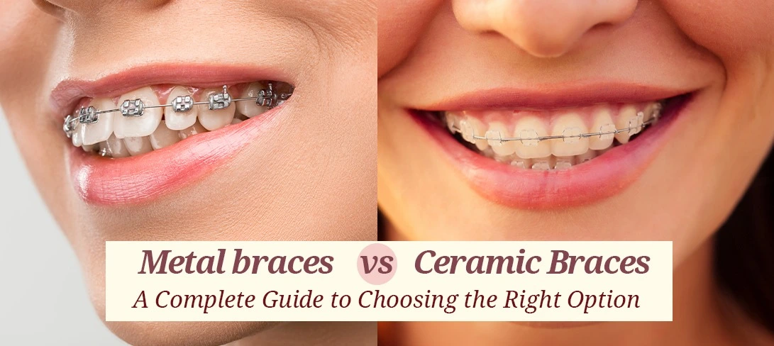 Confused between metallic and ceramic braces? Discover the differences, benefits, and how to choose the perfect option for your orthodontic needs at Clove Dental.