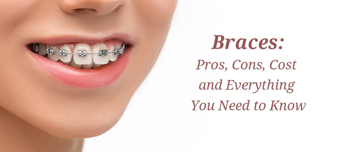 Learn about the pros, cons, and costs of braces in India. And about Clove Dental’s advanced orthodontic solutions, including clear aligners and self-ligating braces.