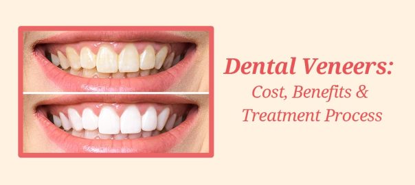 Cost of Dental Veneers Treatment (Porcelain Veneers).