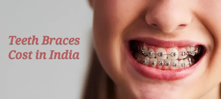 Teeth Braces (Dental Braces) cost in India