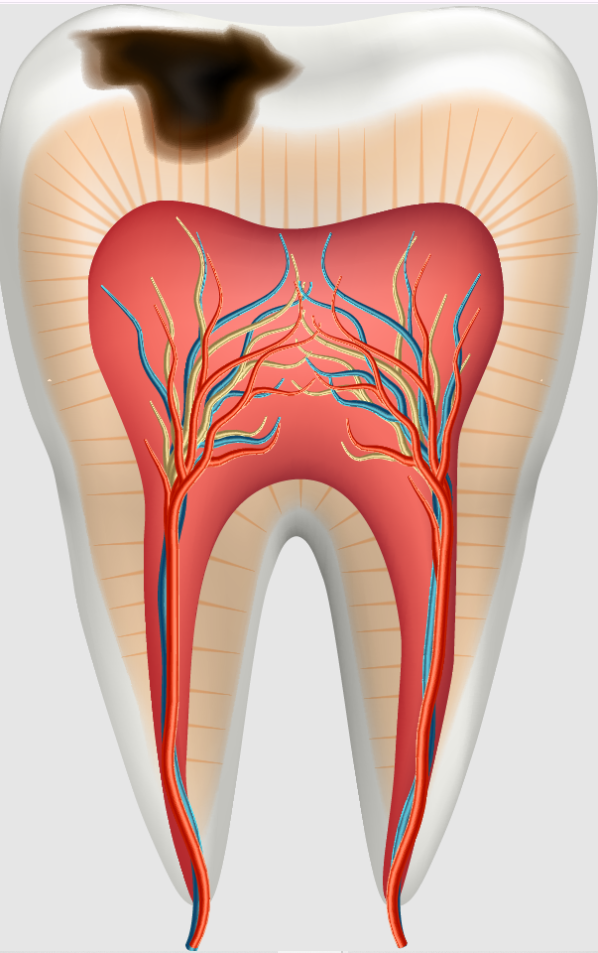 Teeth Cavities 