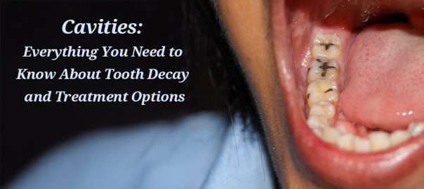 Cavities: Everything You Need to Know About Tooth Decay and Treatment Options