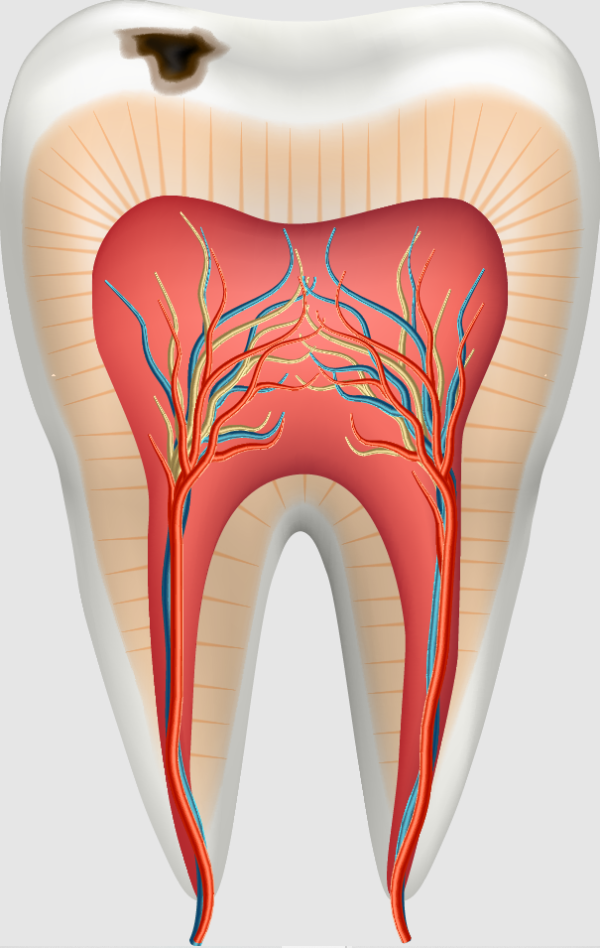 Cavities in teeth