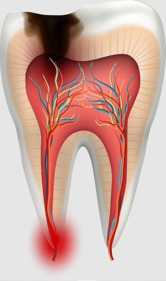Cavity treatment in India