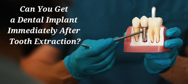 Can You Get a Dental Implant Immediately After Tooth Extraction?