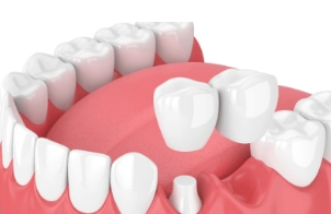 Dental bridges - Cantilever bridges