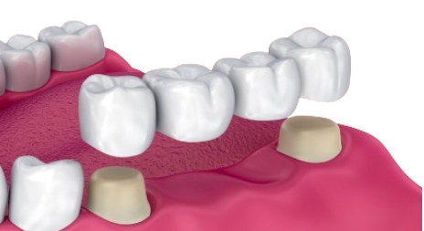 dental bridges - Traditional bridges