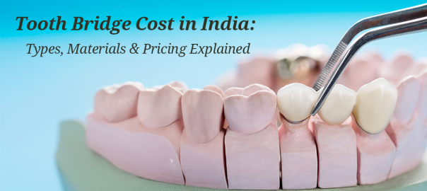 Dental Bridge Cost in India: What to Expect for a Fixed, Long-Term Solution