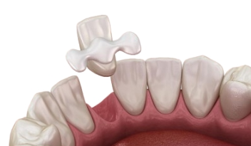 Dental bridges - Maryland bridges