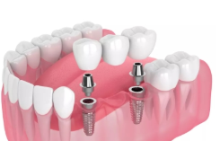 Implant-supported bridges 