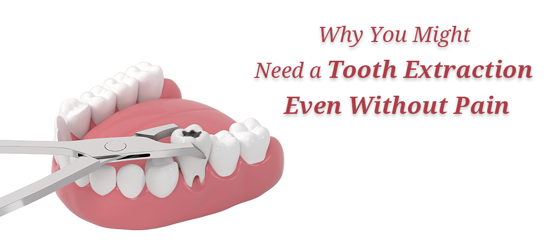 No toothache but your dentist suggests an extraction? Discover the hidden reasons why painless teeth might still need removal and how early action can protect your smile.
