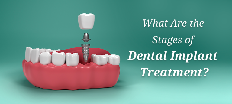What Are The Phases Of The Dental Implant Procedure Image1 768x344