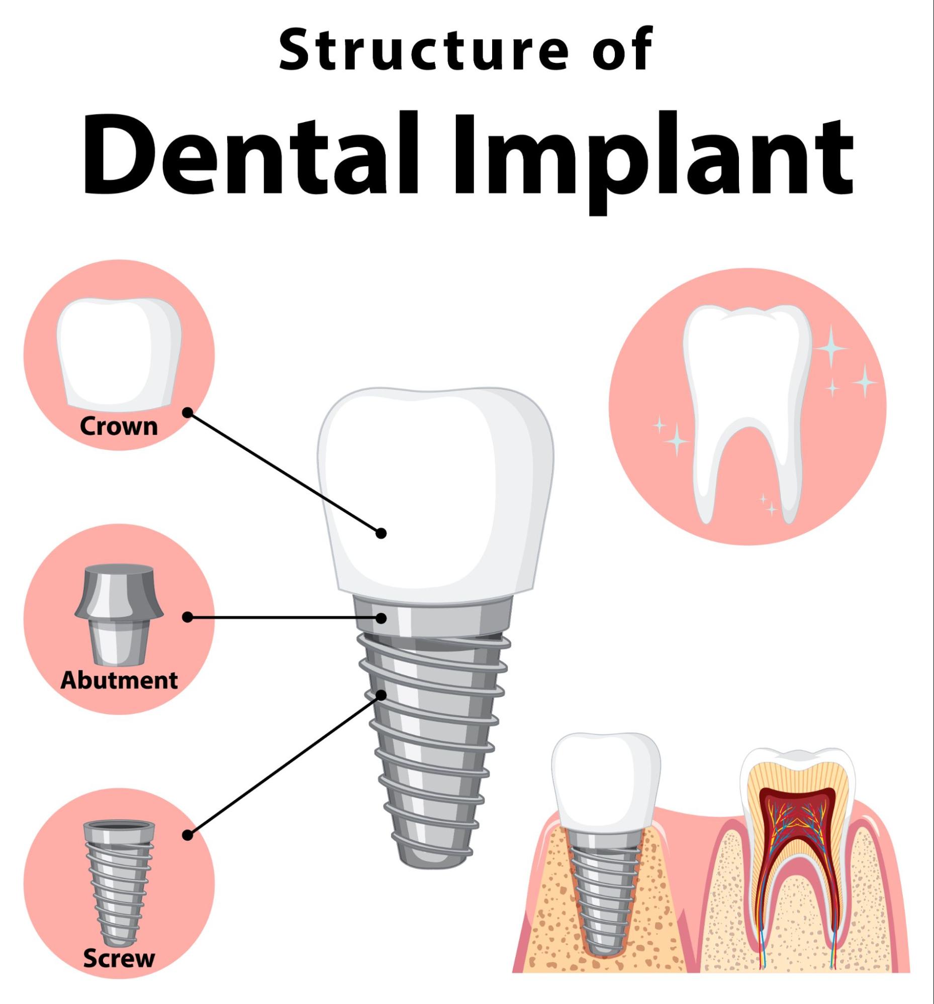 Dental implant structure 