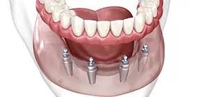 Zygomatic / Pterygoid Implants
