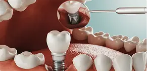 Single tooth dental implants
