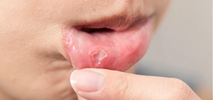 Gummy smile treatment