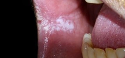 Treating tongue frenulum