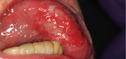 Removing soft tissue