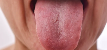 Removing soft tissue