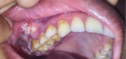 Removing soft tissue