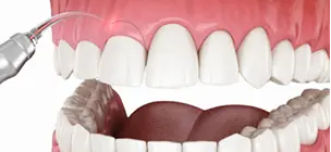 Gummy smile treatment