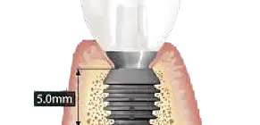 Treating tongue frenulum