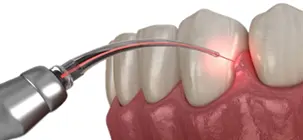 Removing soft tissue