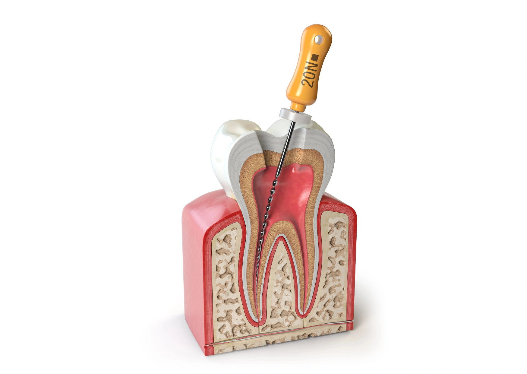 Root Canal Treatment (RCT)