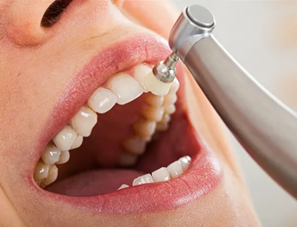 Cracked tooth diagram