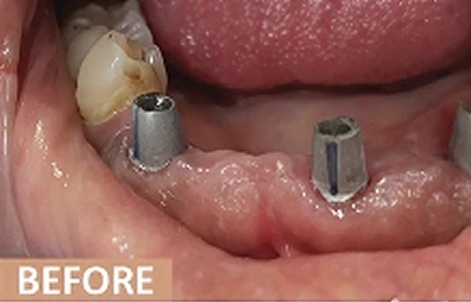 Gummy smile treatment