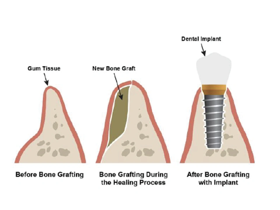 Removing soft tissue