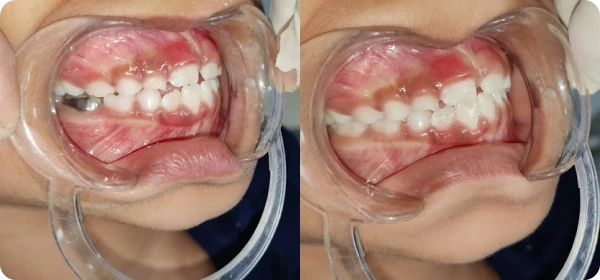 Neha Joshi Before and After