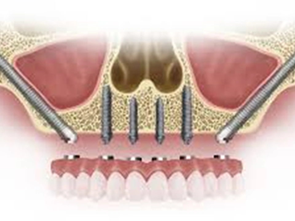 Removing soft tissue
