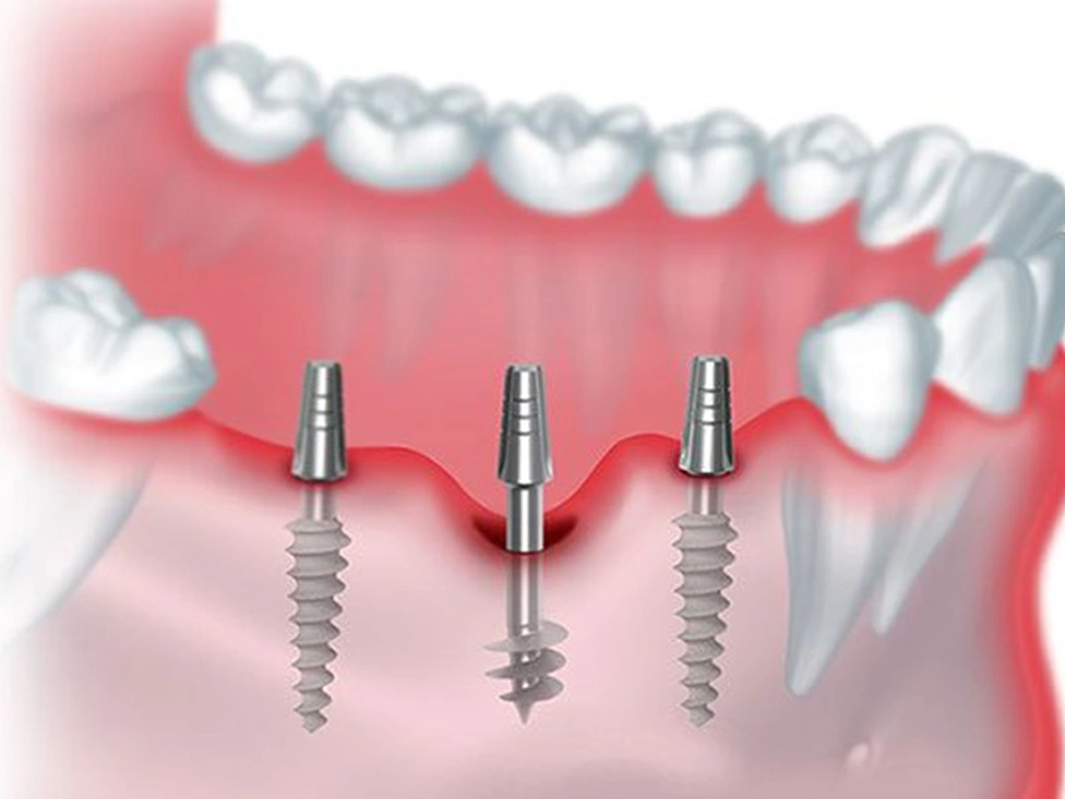 Removing soft tissue