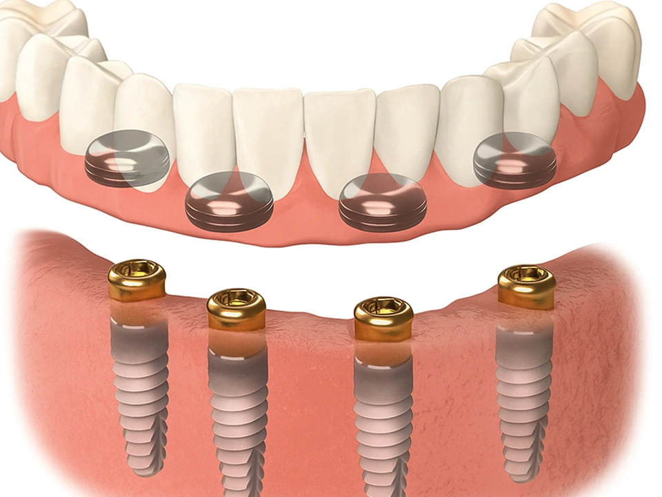 Removing soft tissue