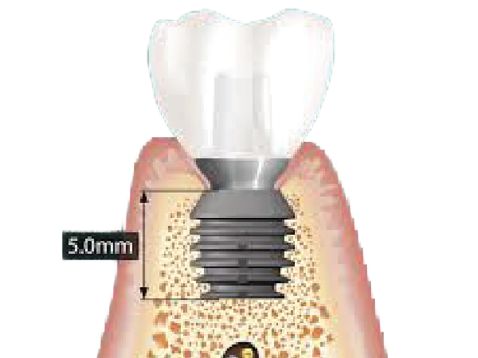 Removing soft tissue