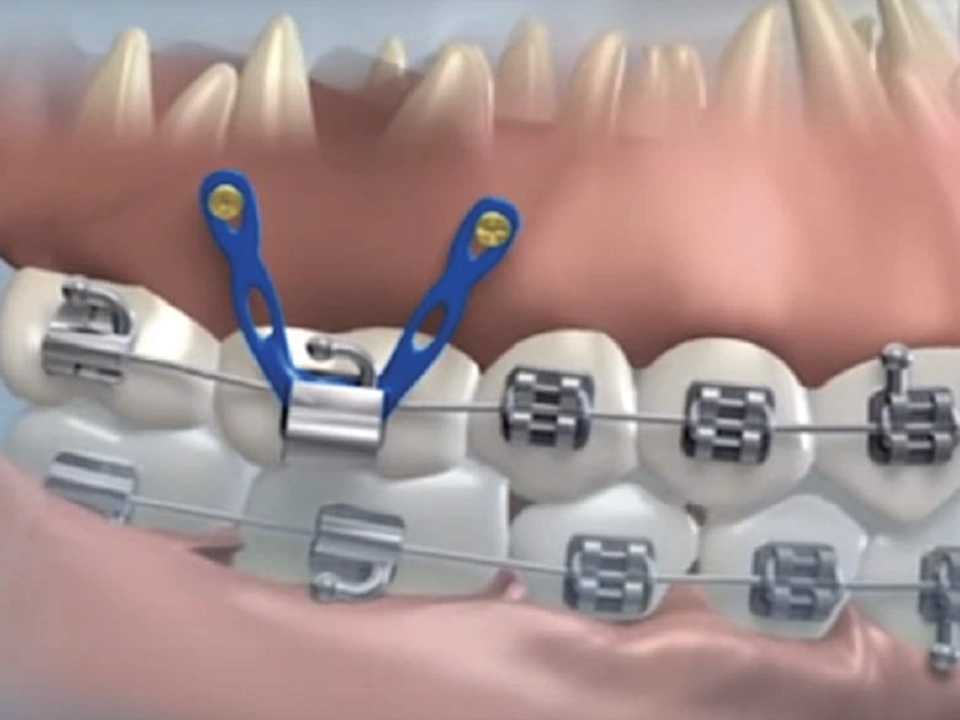 Removing soft tissue