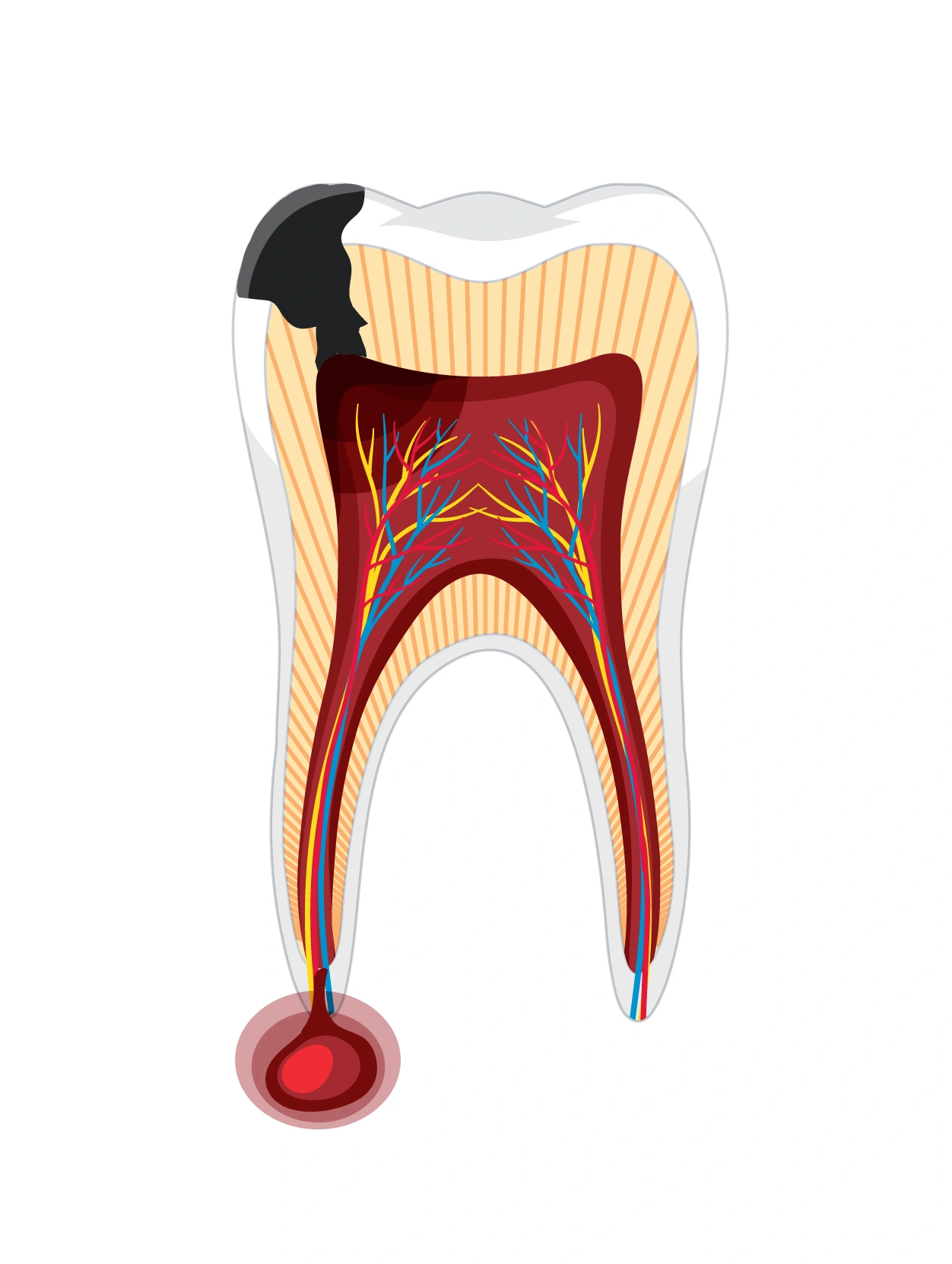 Removing soft tissue