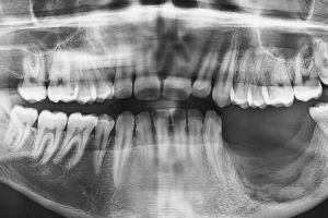 Tooth with large cavity