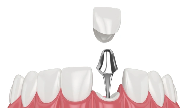 Pus or boil near tooth