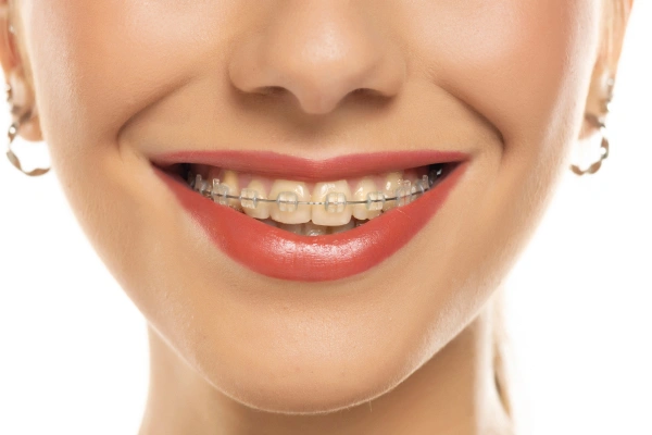 Invisalign Aligners