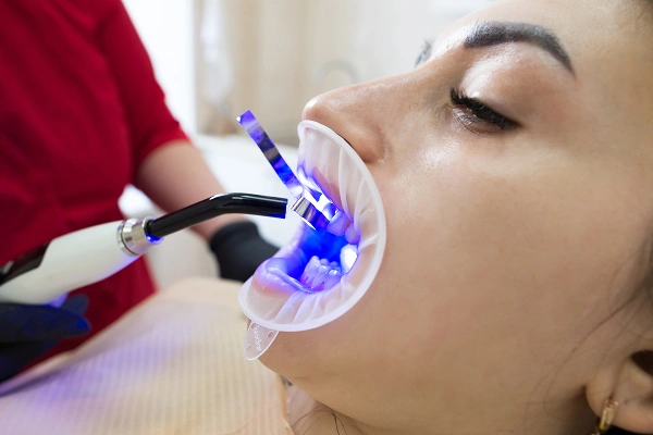 Cracked tooth diagram