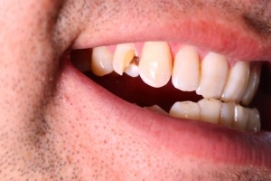 Cracked tooth diagram