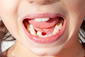 Close-up of discolored teeth