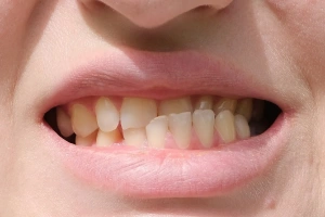 Close-up of discolored teeth