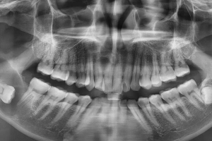 Tooth with large cavity
